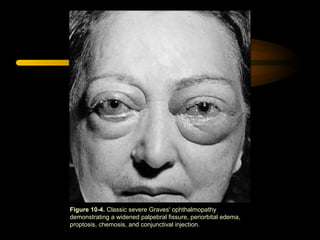 Figure 10-4. Classic severe Graves' ophthalmopathy 
demonstrating a widened palpebral fissure, periorbital edema, 
proptosis, chemosis, and conjunctival injection. 
 