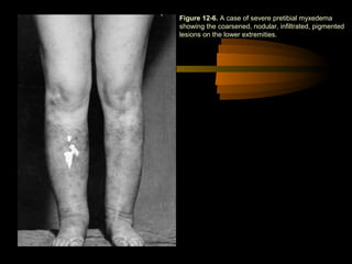 Figure 12-6. A case of severe pretibial myxedema 
showing the coarsened, nodular, infiltrated, pigmented 
lesions on the lower extremities. 
 