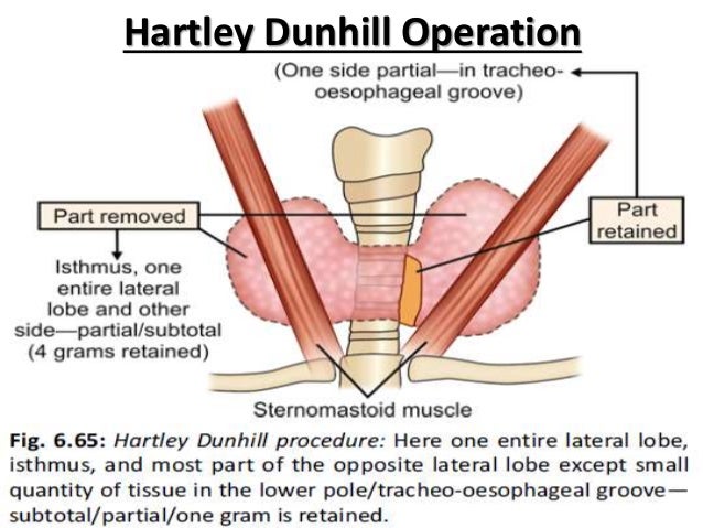 subtotal thyroidectomy
