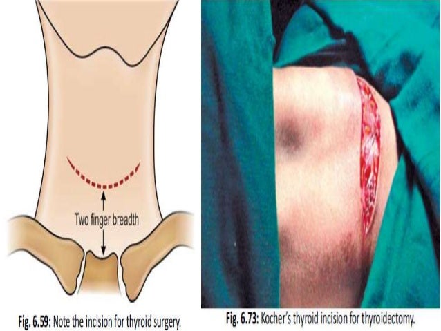 thyroidectomy