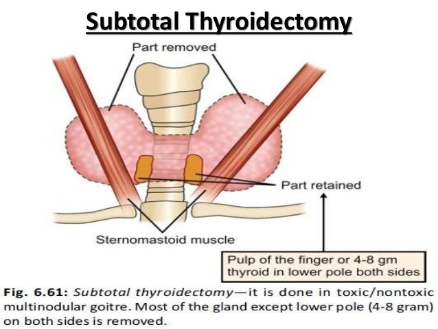 subtotal thyroidectomy