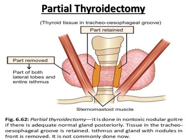 thyroidectomy