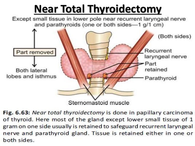 subtotal thyroidectomy