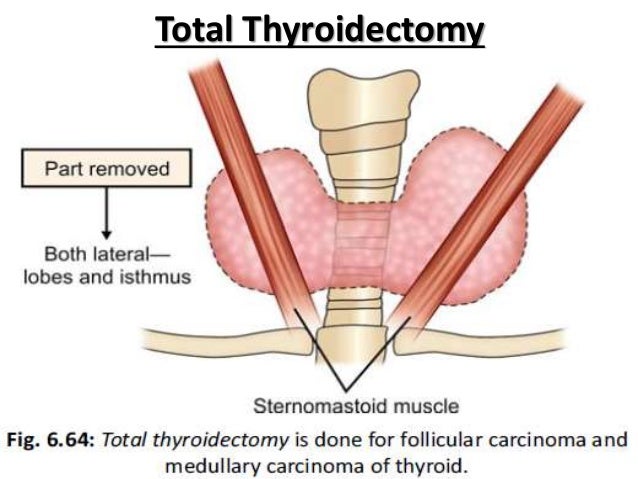 thyroidectomy