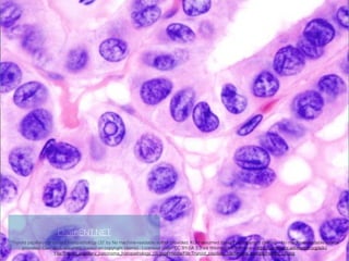"Thyroid papillary carcinoma histopathology (3)" by No machine-readable author provided. KGH assumed (based on copyright claims). - No machine-readable source
provided. Own work assumed (based on copyright claims).. Licensed under CC BY-SA 3.0 via Wikimedia Commons - https://commons.wikimedia.org/wiki/
File:Thyroid_papillary_carcinoma_histopathology_(3).jpg#/media/File:Thyroid_papillary_carcinoma_histopathology_(3).jpg
LearnENT.NET
 