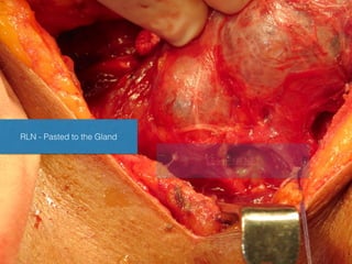 RLN - Pasted to the Gland
LearnENT.NET
 