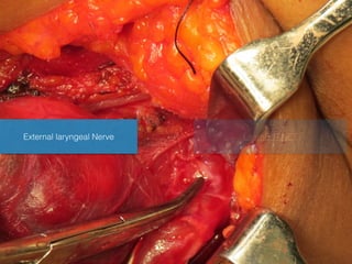 External laryngeal Nerve LearnENT.NET
 