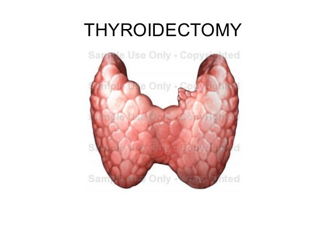 thyroidectomy