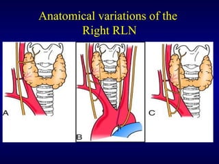 Total Open Thyroidectomy Techniqueslecture.ppt