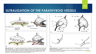 ULTRALIGATION OF THE PARATHYROID VESSELS
30-09-2021
79
 