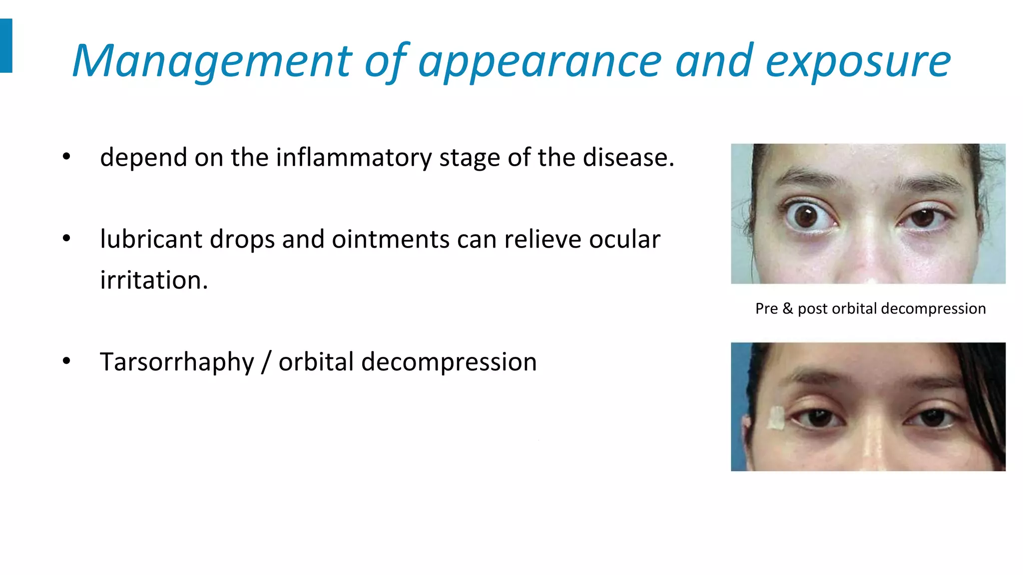 Thyroid eye disease evaluation and management | PPT