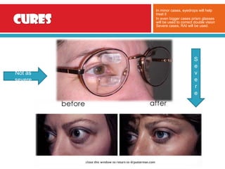 Thyroid Eye Disease [Finished Product] | PPTX