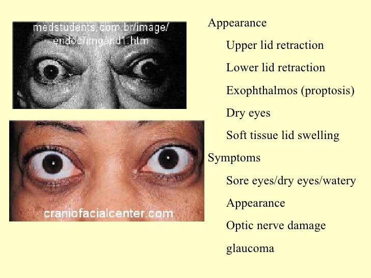 exophthalmos