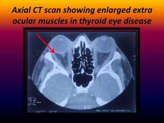 prevalence of patients with
thyroid eye disease
presenting with apparent
unilateral proptosis

 