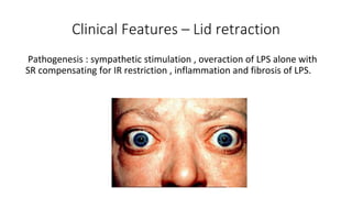 Thyroid eye disease ( Graves Ophthalmopathy ) | PPTX