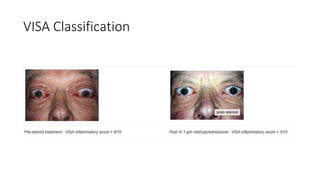 Thyroid eye disease ( Graves Ophthalmopathy ) | PPTX