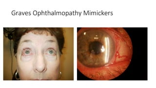 Thyroid eye disease ( Graves Ophthalmopathy ) | PPTX