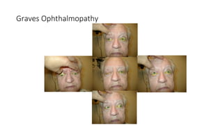 Thyroid eye disease ( Graves Ophthalmopathy ) | PPTX