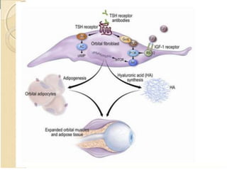 Thyroid eye disease | PPTX