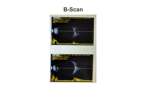 Comprehensive Case Study on Thyroid Eye Disease and Ocular Symptoms | PPTX