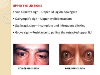 UPPER EYE LID SIGNS
• Von Graefe’s sign—Upper lid lag on downgaze
• Dalrymple’s sign—Upper eyelid retraction
• Stellwag’s sign—Incomplete and infrequent blinking
• Grove sign—Resistance to pulling the retracted upper lid
VON GRAEFE’S SIGN DALRYMPLE’S SIGN
 