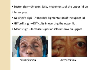 • Boston sign—Uneven, jerky movements of the upper lid on
inferior gaze
• Gellinek’s sign—Abnormal pigmentation of the upper lid
• Gifford’s sign—Difficulty in everting the upper lid
• Means sign—Increase superior scleral show on upgaze
GELLINEK’S SIGN GIFFORD’S SIGN
 