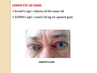 LOWER EYE LID SIGNS
• Enroth’s sign—Edema of the lower lid
• Griffith’s sign—Lower lid lag on upward gaze.
ENROTH’S SIGN
 
