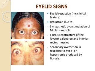 EYELID SIGNS
 Eyelid retraction (mc clinical
feature)
 Retraction due to
- Sympathetic overstimulation of
Muller’s muscle
- Fibrotic contracture of the
levator palpebrae and inferior
rectus muscles
- Secondary overaction in
response to hypo- or
hypertropia produced by
fibrosis.
 