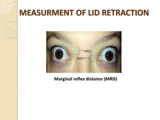Marginal reflex distance (MRD)
MEASURMENT OF LID RETRACTION
 