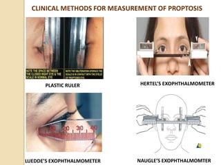 PLASTIC RULER
LUEDDE’S EXOPHTHALMOMETER
HERTEL’S EXOPHTHALMOMETER
CLINICAL METHODS FOR MEASUREMENT OF PROPTOSIS
NAUGLE’S EXOPHTHALMOMTER
 