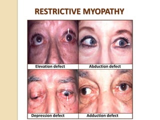 RESTRICTIVE MYOPATHY
Elevation defect Abduction defect
Depression defect Adduction defect
 