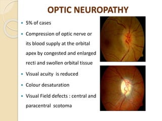 OPTIC NEUROPATHY
 5% of cases
 Compression of optic nerve or
its blood supply at the orbital
apex by congested and enlarged
recti and swollen orbital tissue
 Visual acuity is reduced
 Colour desaturation
 Visual Field defects : central and
paracentral scotoma
 