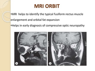 MRI ORBIT
•MRI helps to identify the typical fusiform rectus muscle
enlargement and orbital fat expansion
•Helps in early diagnosis of compressive optic neuropathy
 