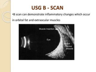 USG B - SCAN
•B scan can demonstrate inflammatory changes which occur
in orbital fat and extraocular muscles
 