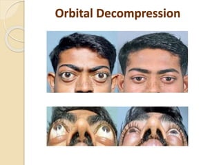 Orbital Decompression
 