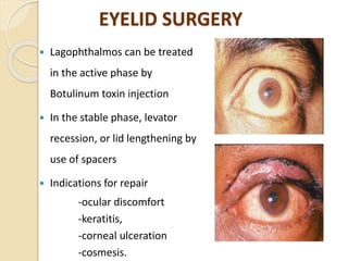 EYELID SURGERY
 Lagophthalmos can be treated
in the active phase by
Botulinum toxin injection
 In the stable phase, levator
recession, or lid lengthening by
use of spacers
 Indications for repair
-ocular discomfort
-keratitis,
-corneal ulceration
-cosmesis.
 