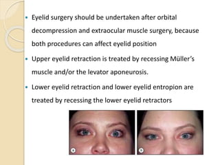  Eyelid surgery should be undertaken after orbital
decompression and extraocular muscle surgery, because
both procedures can affect eyelid position
 Upper eyelid retraction is treated by recessing Müller’s
muscle and/or the levator aponeurosis.
 Lower eyelid retraction and lower eyelid entropion are
treated by recessing the lower eyelid retractors
 