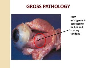 GROSS PATHOLOGY
EOM
enlargement
confined to
bellies and
sparing
tendons
 