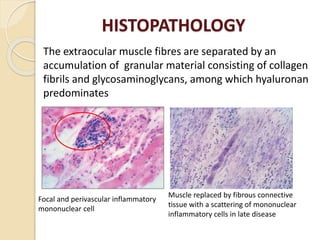 HISTOPATHOLOGY
The extraocular muscle fibres are separated by an
accumulation of granular material consisting of collagen
fibrils and glycosaminoglycans, among which hyaluronan
predominates
Focal and perivascular inflammatory
mononuclear cell
Muscle replaced by fibrous connective
tissue with a scattering of mononuclear
inflammatory cells in late disease
 