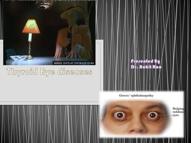 Thyroid eye diseases | PPT | Thyroid Disorders | Endocrine and ...