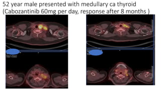 Targeted Therapies in Thyroid Cancer ppt.pptx