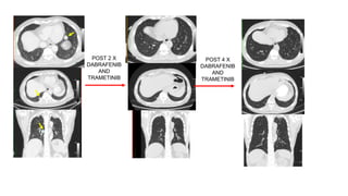 Targeted Therapies in Thyroid Cancer ppt.pptx