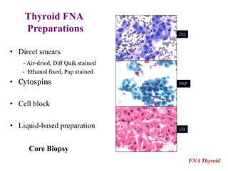 Thyroid FNA 
Preparations 
• Direct smears 
- Air-dried, Diff Quik stained 
- Ethanol fixed, Pap stained 
• Cytospins 
• Cell block 
• Liquid-based preparation 
FNA Thyroid 
DQ 
PAP 
CB 
Core Biopsy 
 