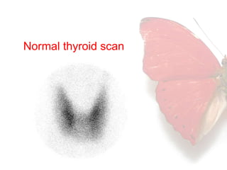 Normal thyroid scan 
 
