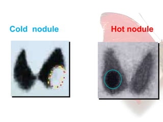 Cold nodule Hot nodule 
 