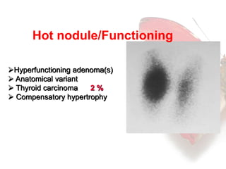 Hot nodule/Functioning 
Hyperfunctioning adenoma(s) 
 Anatomical variant 
 Thyroid carcinoma 2 % 
 Compensatory hypertrophy 
 