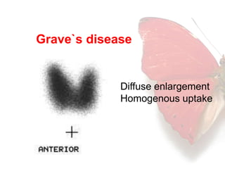 Grave`s disease 
Diffuse enlargement 
Homogenous uptake 
 