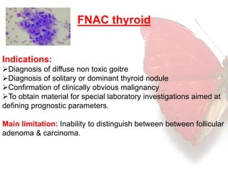 FNAC thyroid 
Indications: 
Diagnosis of diffuse non toxic goitre 
Diagnosis of solitary or dominant thyroid nodule 
Confirmation of clinically obvious malignancy 
To obtain material for special laboratory investigations aimed at 
defining prognostic parameters. 
Main limitation: Inability to distinguish between between follicular 
adenoma & carcinoma. 
 