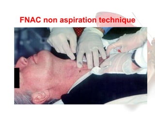 FNAC non aspiration technique 
 