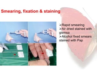 Smearing, fixation & staining 
Rapid smearing 
Air dried stained with 
giemsa 
Alcohol fixed smears 
stained with Pap 
 
